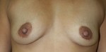 Breast Augmentation