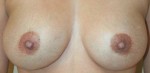 Breast Augmentation