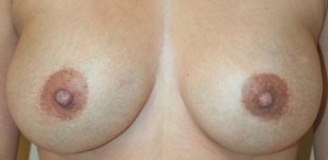 Breast Augmentation
