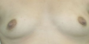 Breast Augmentation