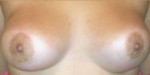 Breast Augmentation