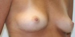 Breast Augmentation