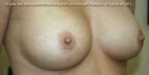 Breast Augmentation
