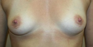 Breast Augmentation