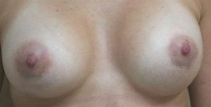 Breast Augmentation