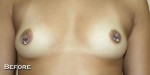Breast Augmentation