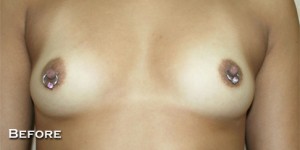 Breast Augmentation