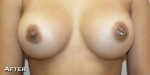 Breast Augmentation