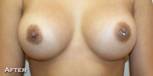 Breast Augmentation