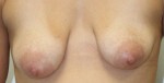 Breast Augmentation