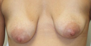 Breast Augmentation