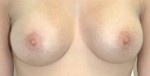 Breast Augmentation