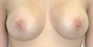 Breast Augmentation