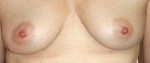 Breast Augmentation