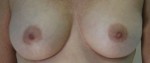 Breast Augmentation