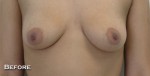 Breast Augmentation