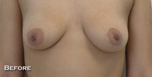 Breast Augmentation