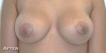 Breast Augmentation