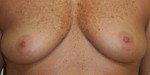 Breast Augmentation