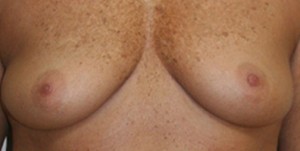 Breast Augmentation