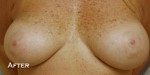 Breast Augmentation