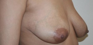 Breast Augmentation