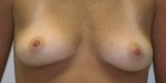 Breast Augmentation