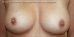 Breast Augmentation