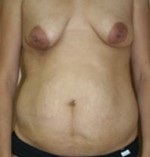 Breast Augmentation
