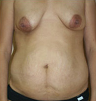 Breast Augmentation