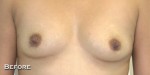 Breast Augmentation