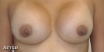 Breast Augmentation