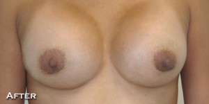 Breast Augmentation