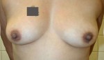 Breast Augmentation