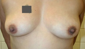 Breast Augmentation