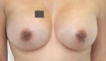 Breast Augmentation