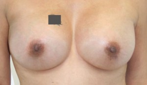 Breast Augmentation