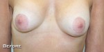 Breast Augmentation