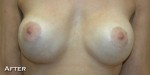 Breast Augmentation
