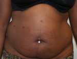 Tummy Tuck (Abdominoplasty)