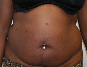 Tummy Tuck (Abdominoplasty)