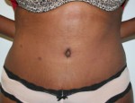 Tummy Tuck (Abdominoplasty)