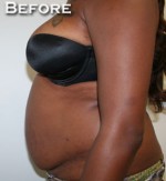 Tummy Tuck (Abdominoplasty)