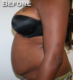 Tummy Tuck (Abdominoplasty)