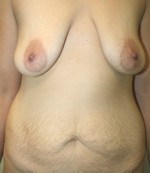 Tummy Tuck (Abdominoplasty)
