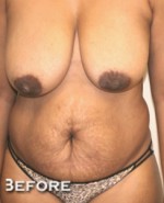 Tummy Tuck (Abdominoplasty)