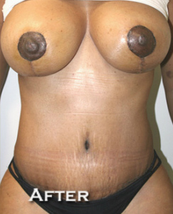 Tummy Tuck (Abdominoplasty)