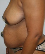 Tummy Tuck (Abdominoplasty)