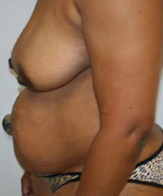 Tummy Tuck (Abdominoplasty)