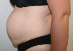 Tummy Tuck (Abdominoplasty)